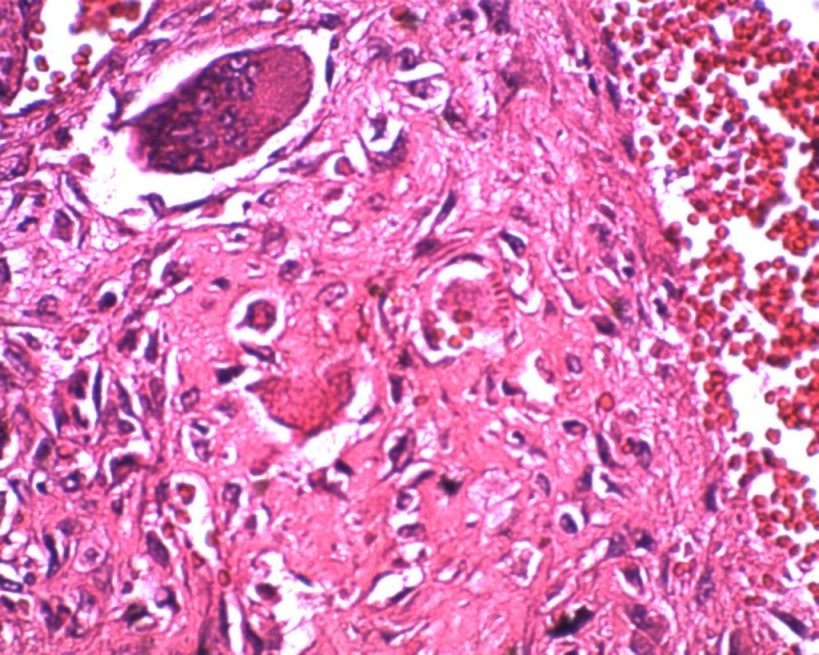 Giant cell tumor of tendon sheath under high power (40X, H/E) :shows an admixture of polygonal and spindle shaped mononuclear cells, xanthoma cells, multinucleated gaint cells in a collagenous, variably hyalinised stroma was seen .